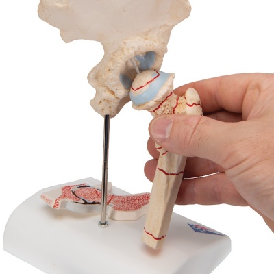 3B Scientific Hip Model with Femoral Fracture and Osteoarthritis (Right)